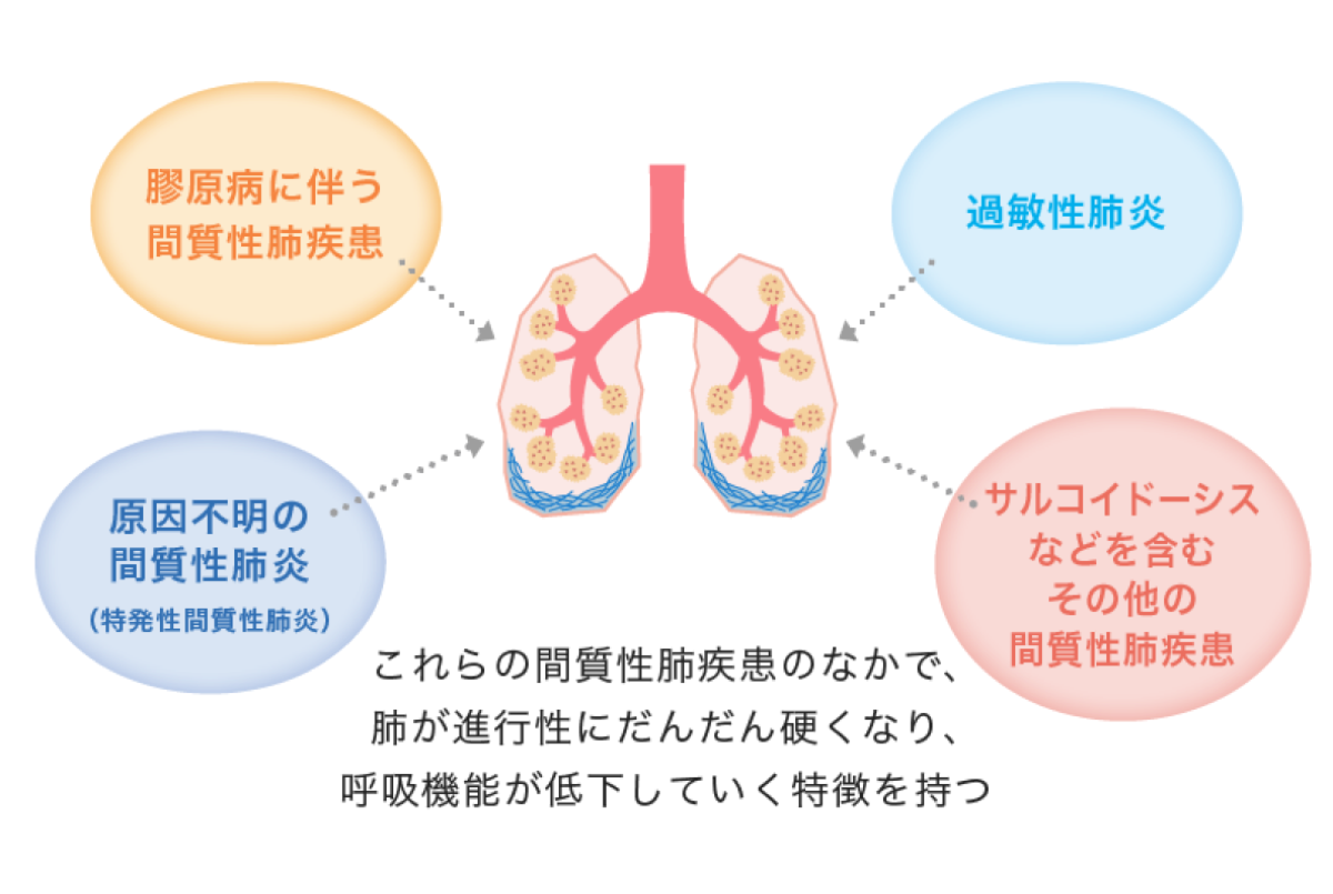 進行性線維化を伴う間質性肺疾患とは？