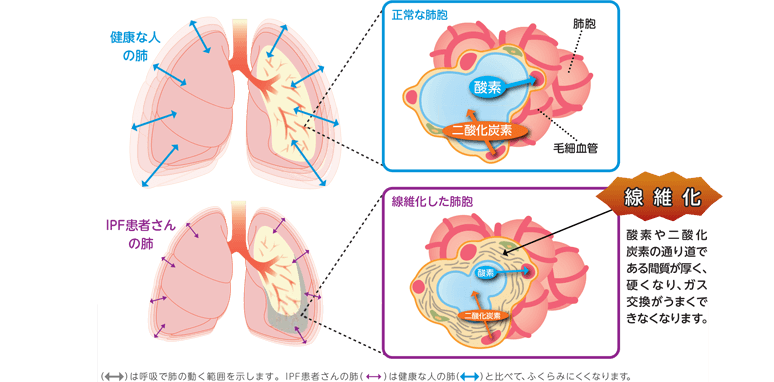4.1.2-01-disease-pc.png