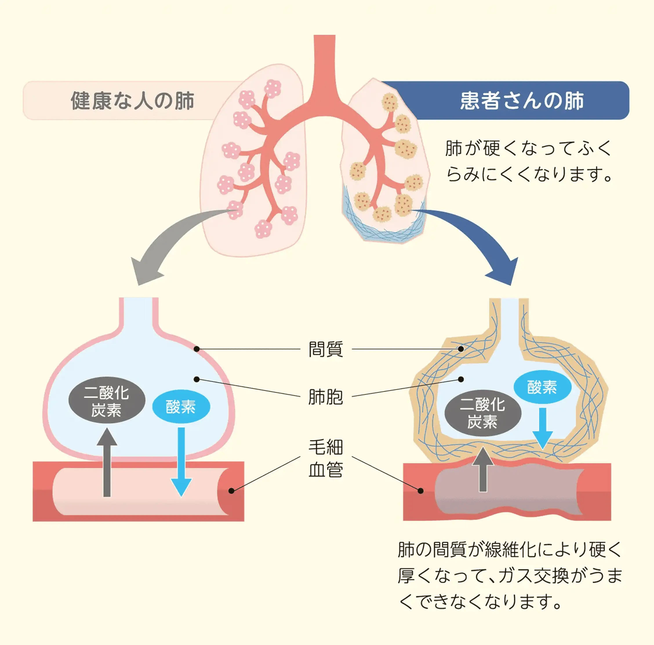 肺の線維化によって肺の症状がおこるしくみ