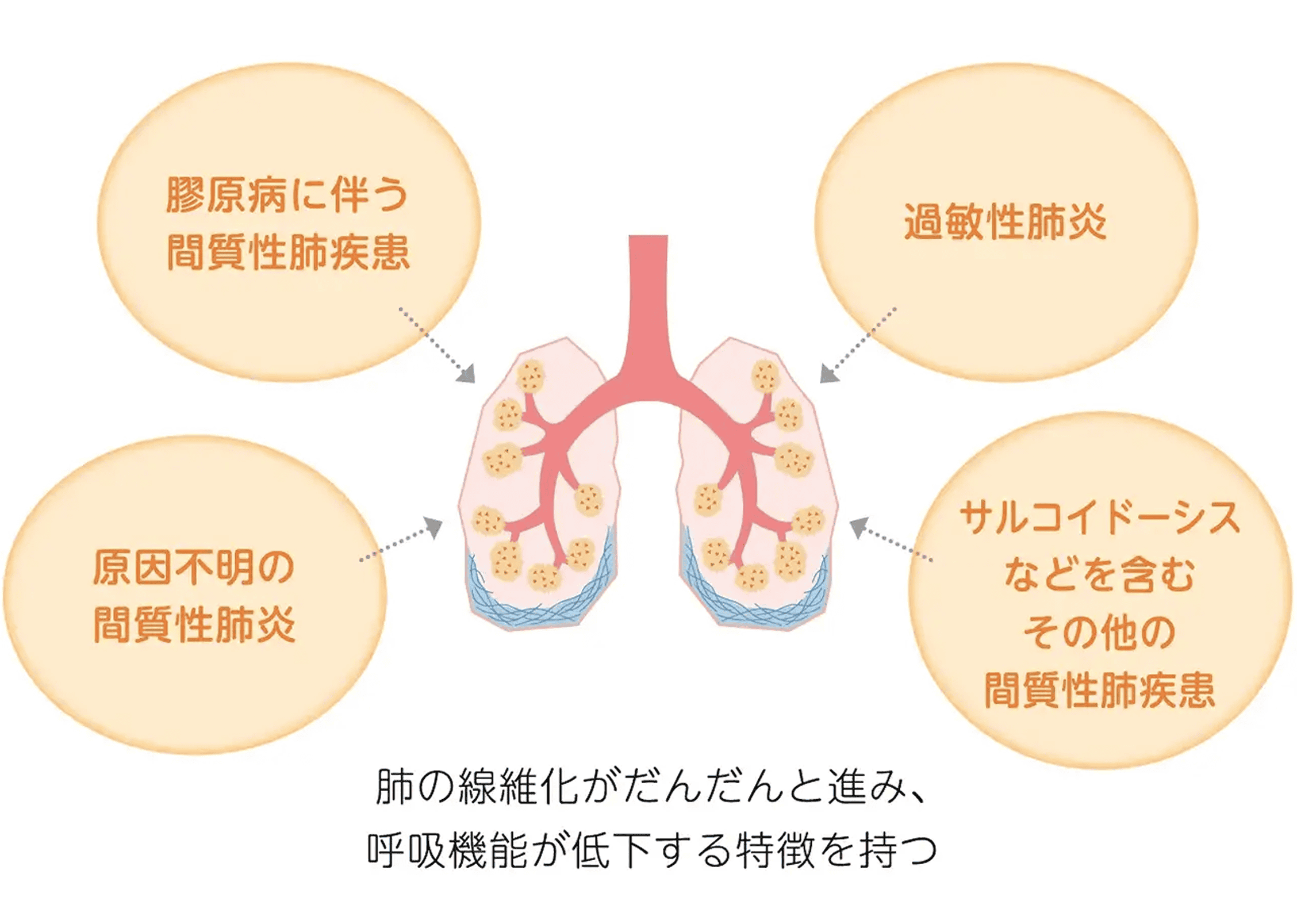 ofev_disease