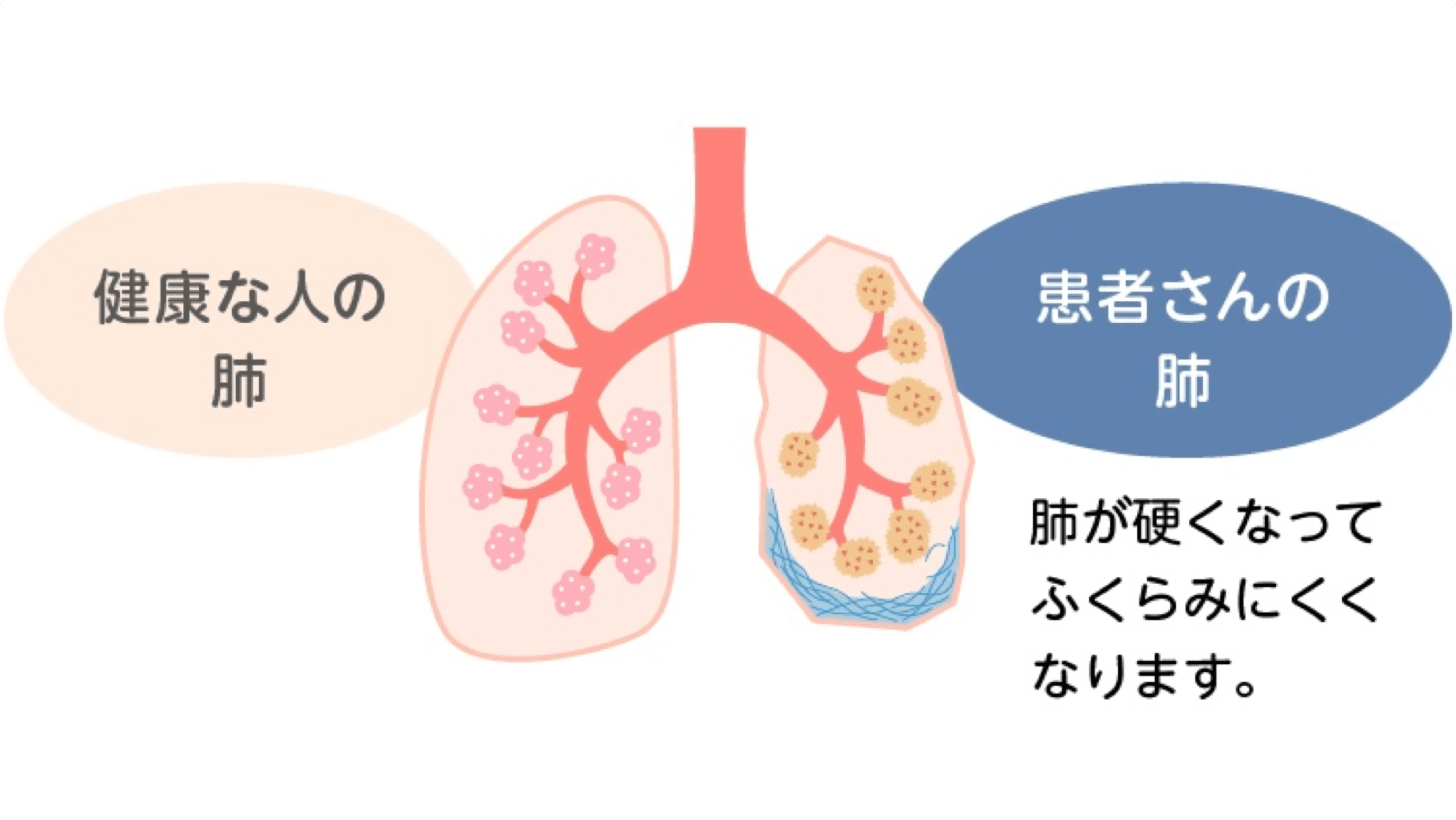 間質性肺疾患とは︖