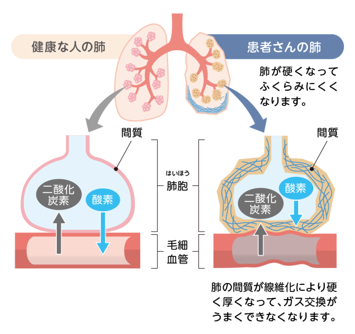 間質性肺疾患とは︖