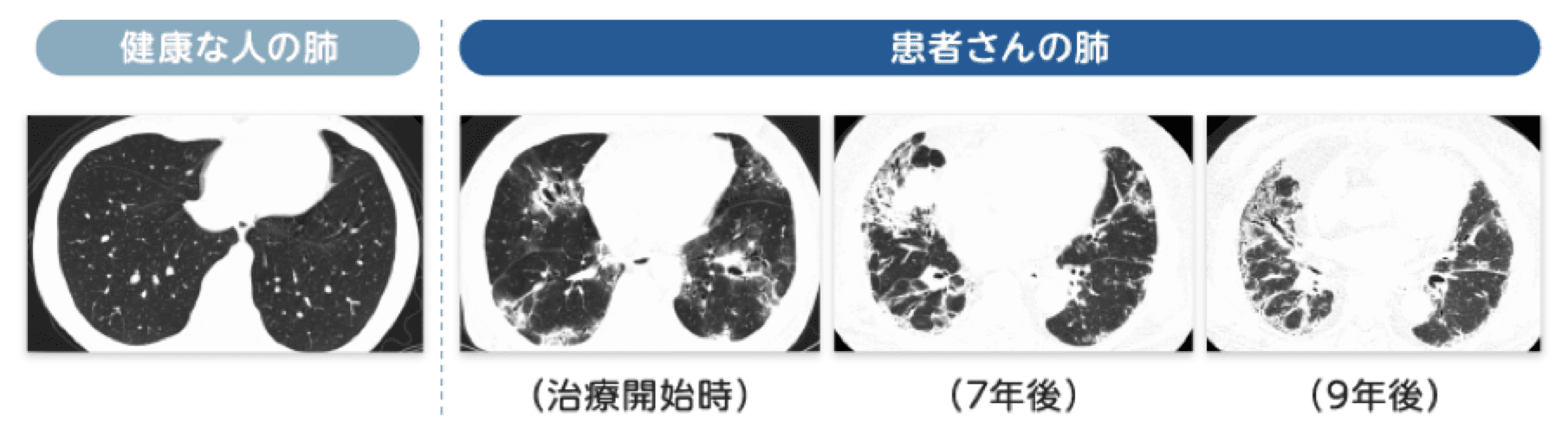 肺の状態について